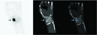 bone scan